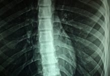 Experimental drug restores some bladder function after spinal cord injury