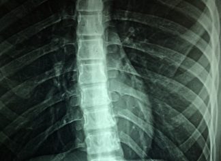 Experimental drug restores some bladder function after spinal cord injury