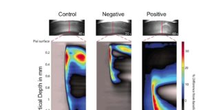 Researchers has identified the electrical activity specific to the start of migraines and demonstrated a way to stop it in animal experiments