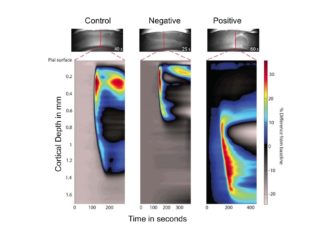 Researchers has identified the electrical activity specific to the start of migraines and demonstrated a way to stop it in animal experiments