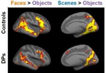 Researchers report developmental prosopagnosia, or face blindness, occurs as the results of neurobiological problems that broadly affect visual recognition
