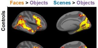 Researchers report developmental prosopagnosia, or face blindness, occurs as the results of neurobiological problems that broadly affect visual recognition