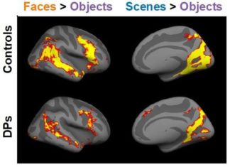 Researchers report developmental prosopagnosia, or face blindness, occurs as the results of neurobiological problems that broadly affect visual recognition