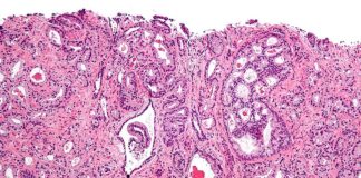 Scientists found scores of new genetic markers in DNA code that increase prostate cancer risk