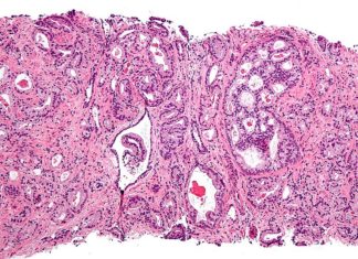 Scientists found scores of new genetic markers in DNA code that increase prostate cancer risk