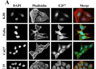 University of Queensland researchers have discovered how to reverse drug resistance in skin and mouth squamous cell carcinomas