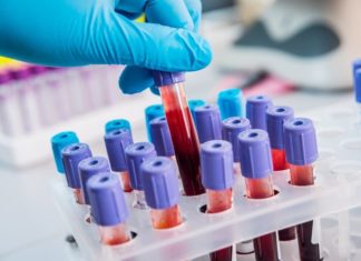 World-first test could predict risk of heart attack in coronary artery disease patients