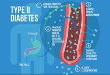 Patients with Type 2 diabetes who were treated with the newer generation of insulin analog drugs did not have substantially better outcomes than those treated with less costly human insulin