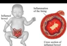 Carbohydrates in infant formula shape gut metabolites profile