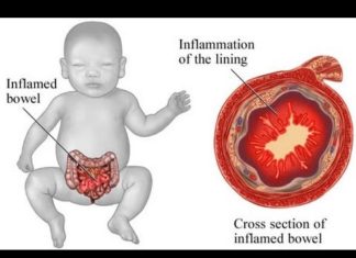 Carbohydrates in infant formula shape gut metabolites profile