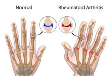 Peripheral inflammation is associated with brain connectivity and structure in those with rheumatoid arthritis