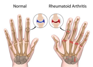 Peripheral inflammation is associated with brain connectivity and structure in those with rheumatoid arthritis