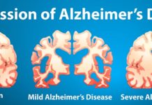 Researchers provide a statistical analysis of ‘saving appearance responses’ in patients with dementia. The study reveals the SAR responses are particularly common in those with Alzheimer’s disease