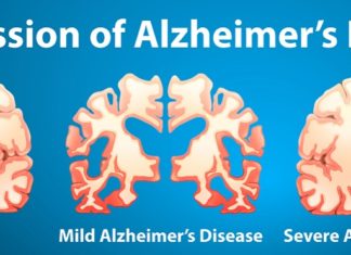 Researchers provide a statistical analysis of ‘saving appearance responses’ in patients with dementia. The study reveals the SAR responses are particularly common in those with Alzheimer’s disease