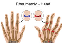 A new gene associated with disease severity in models of rheumatoid arthritis has been identified by researchers at the Icahn School of Medicine at Mount Sinai