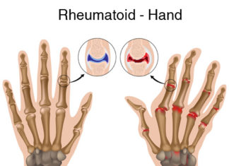 A new gene associated with disease severity in models of rheumatoid arthritis has been identified by researchers at the Icahn School of Medicine at Mount Sinai