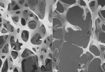A new genetic screen may predict a person’s future risk of osteoporosis and bone fracture