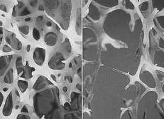 A new genetic screen may predict a person’s future risk of osteoporosis and bone fracture