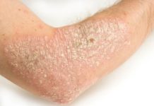 A study of more than 3,500 French psoriasis patients found that the healthier their diet, the less severe their symptoms