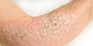 A study of more than 3,500 French psoriasis patients found that the healthier their diet, the less severe their symptoms