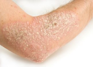 A study of more than 3,500 French psoriasis patients found that the healthier their diet, the less severe their symptoms