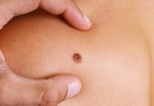 Australian researchers said Wednesday they have developed a blood test for melanoma in its early stages