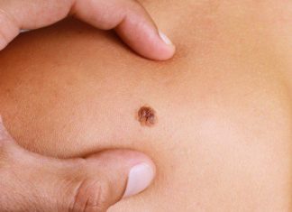 Australian researchers said Wednesday they have developed a blood test for melanoma in its early stages
