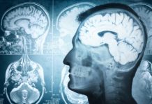 Brain tumour chemotherapy now available to even more NHS patients