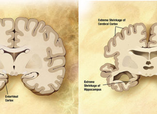 Yale researchers have tested a new method for directly measuring synaptic loss in individuals with Alzheimer’s disease