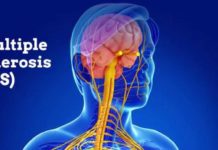 Found the molecular key for delaying the progression of multiple sclerosis