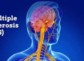 Found the molecular key for delaying the progression of multiple sclerosis