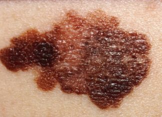 Innovative CRISPR study recreates genetic steps required for benign moles to turn malignant