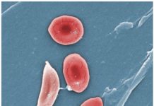 Medical researchers find innovative drug to treat sickle cell disease (SCD)