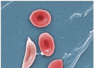 Medical researchers find innovative drug to treat sickle cell disease (SCD)