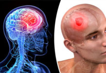 Men and Women Have Different Genetic Risk Factors for Developing Brain Cancer