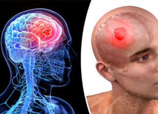 Men and Women Have Different Genetic Risk Factors for Developing Brain Cancer