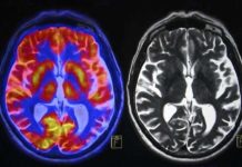 Moments of insight : Brain scans reveal bursts of high frequency oscillations