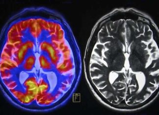 Moments of insight : Brain scans reveal bursts of high frequency oscillations