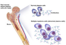 Diagnosing myeloma: When you test the serum, we suggest you also test the urine whenever you suspect that somebody has a tumor of the plasma cells