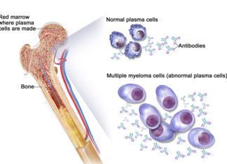 Diagnosing myeloma: When you test the serum, we suggest you also test the urine whenever you suspect that somebody has a tumor of the plasma cells