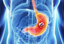 New marker for favourable prognosis in gastric and esophageal cancer