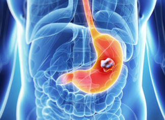 New marker for favourable prognosis in gastric and esophageal cancer