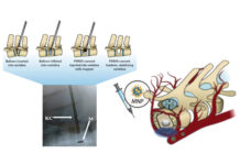 Patients with spinal fractures caused by tumors or osteoporosis usually undergo a procedure called kyphoplasty, where the fracture is filled with surgical cement