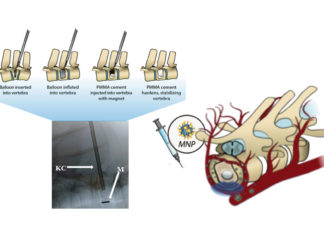 Patients with spinal fractures caused by tumors or osteoporosis usually undergo a procedure called kyphoplasty, where the fracture is filled with surgical cement