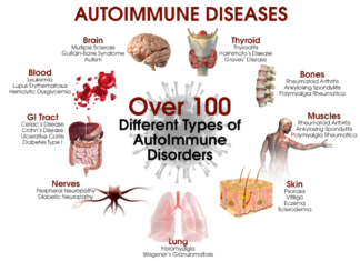 Link between a number of autoimmune diseases and an increased risk of developing psychosis