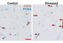 Scientists have uncovered a potential approach to treat one of the commonest causes of dementia and stroke in older people