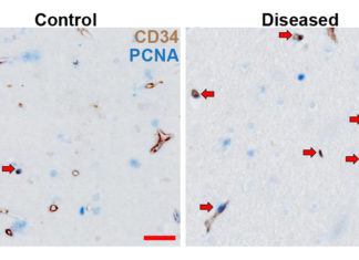 Scientists have uncovered a potential approach to treat one of the commonest causes of dementia and stroke in older people