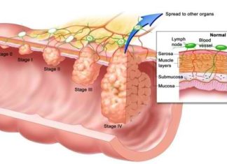 Even if it’s not visible to the naked eye, blood in the stool can be serious – a sign of a potentially fatal disease other than colon cancer, new research suggests