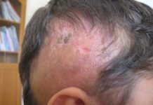 Experimental drug reverses hair loss and skin damage linked to fatty diet
