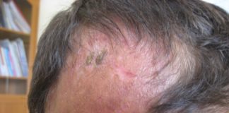 Experimental drug reverses hair loss and skin damage linked to fatty diet